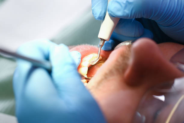 Best Emergency Wisdom Tooth Extraction in Paris, KY